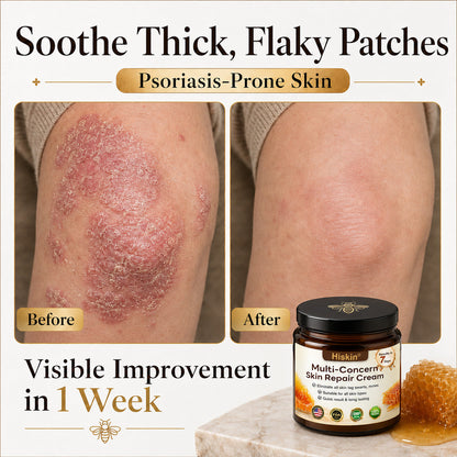 ✨HISKIN® Multi-Concern Skin Repair Cream (One powerful cream to repair inflammation, dryness, aging, pigmentation, and visible skin damage.)